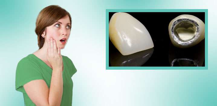 Ce ar trebui să faceți în situația în care coroana dentară se desprinde de pe dinte?