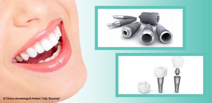 Scurtă istorie a implantului dentar