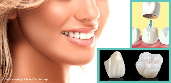 Ce este o coroană dentară?
