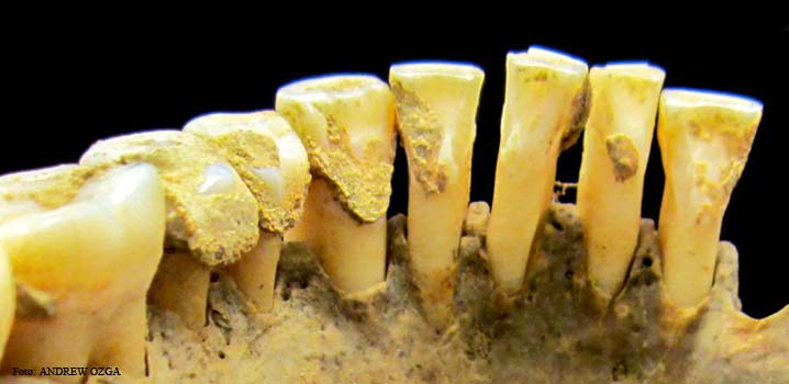 Tartrul dentar deține indicii despre lumea străveche