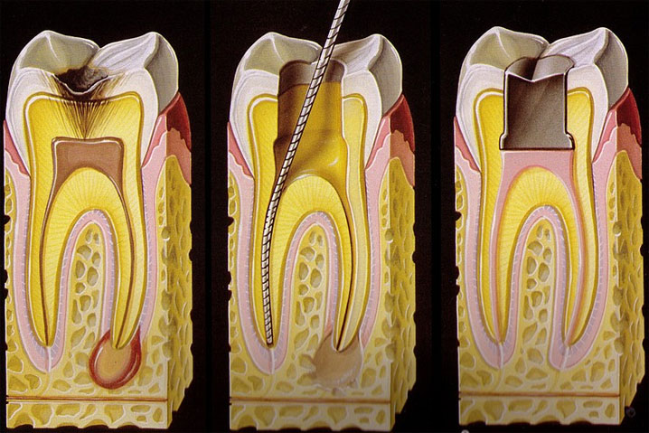 clinică stomatologică bucurești - endodontie