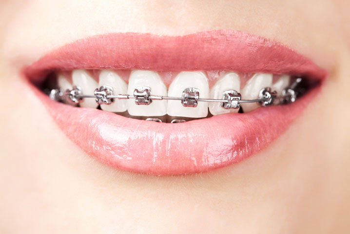 clinică stomatologică bucurești - ortodontie
